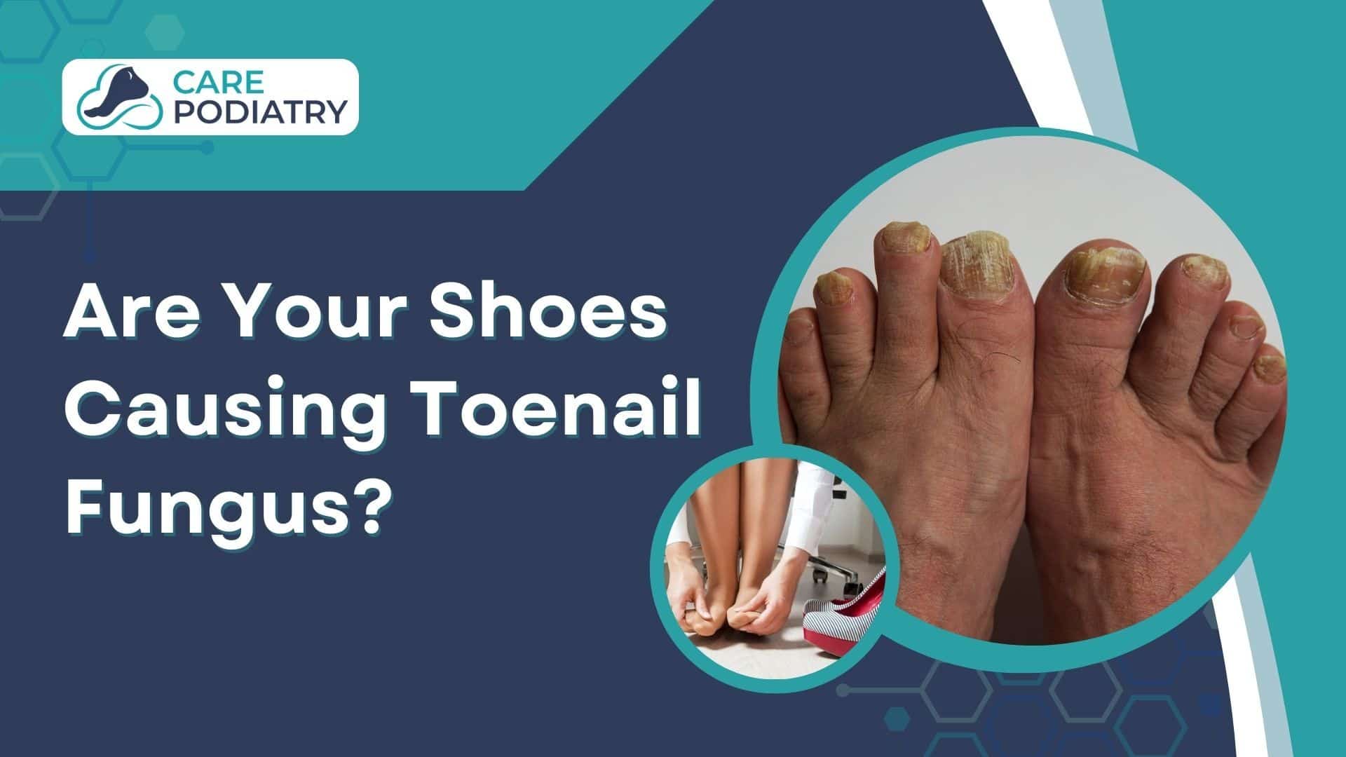 Are Your Shoes Causing Toenail Fungus
