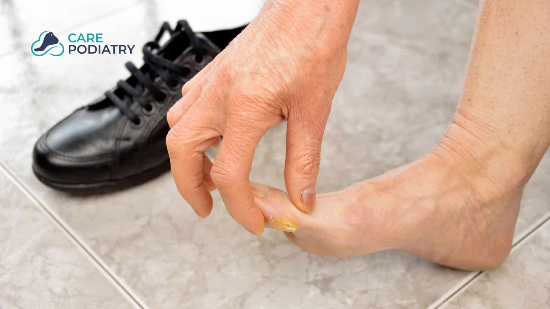 Do Shoes Cause Toenail Fungus