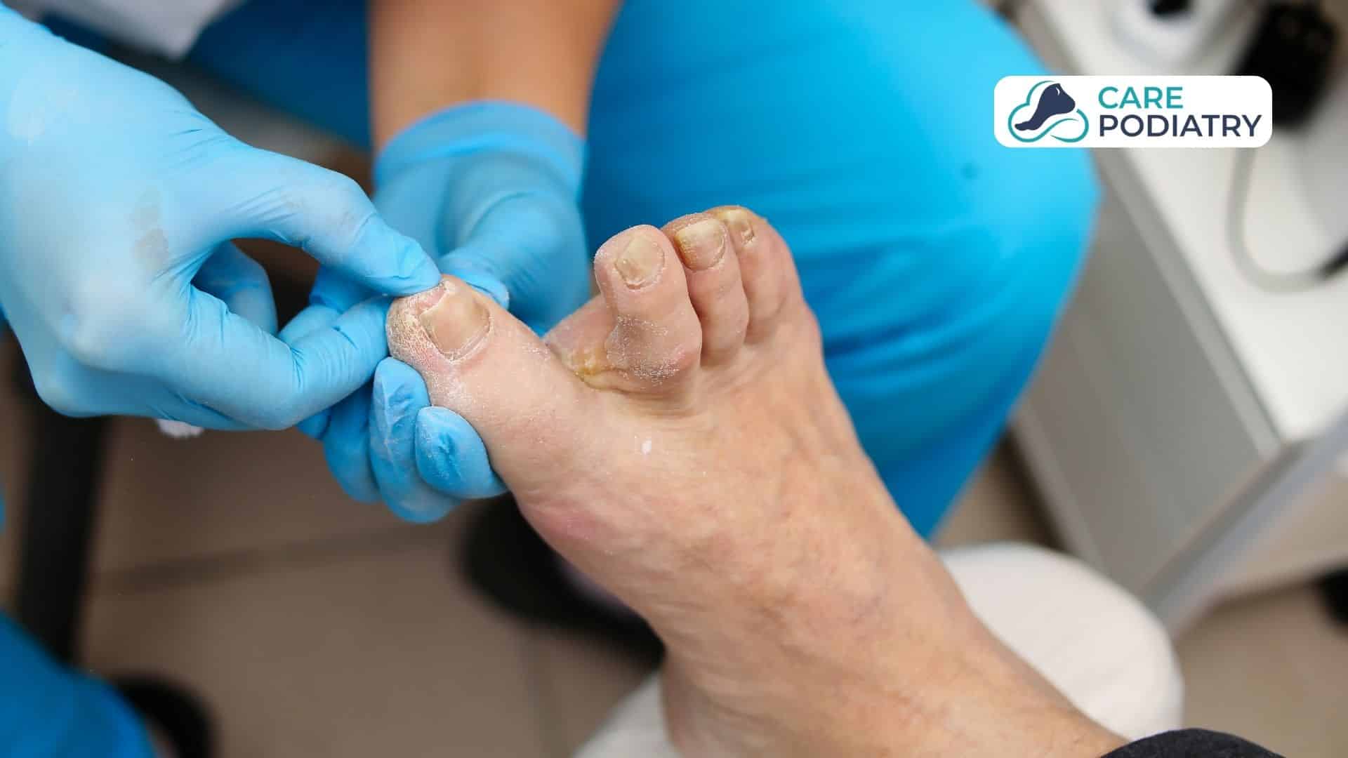 How To Get Rid of Toenail Fungus Nail Removal