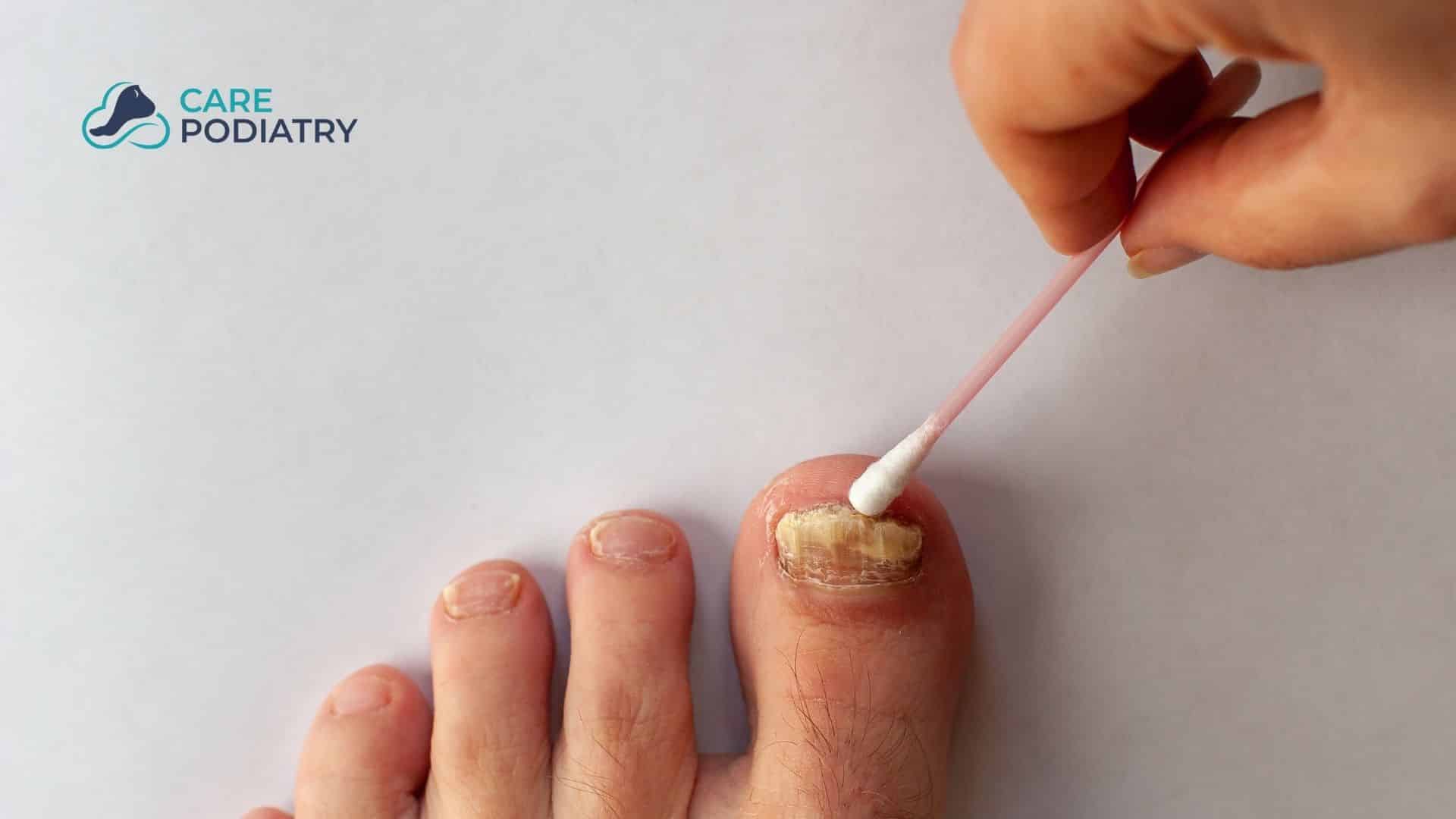How To Get Rid of Toenail Fungus Prescription remedies for toenail fungus