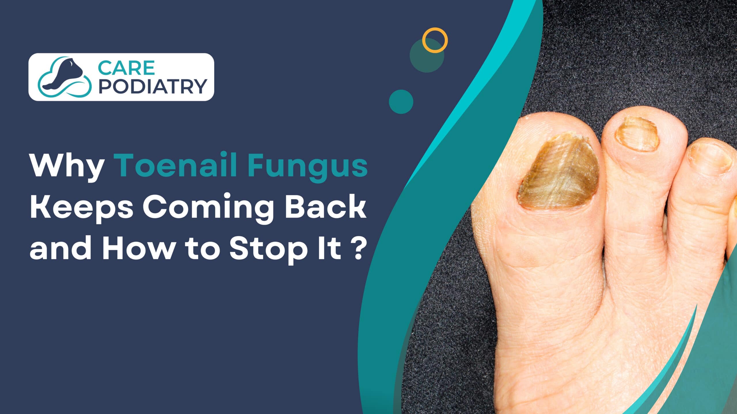 Why Toenail Fungus Keeps Coming Back and How to Stop It