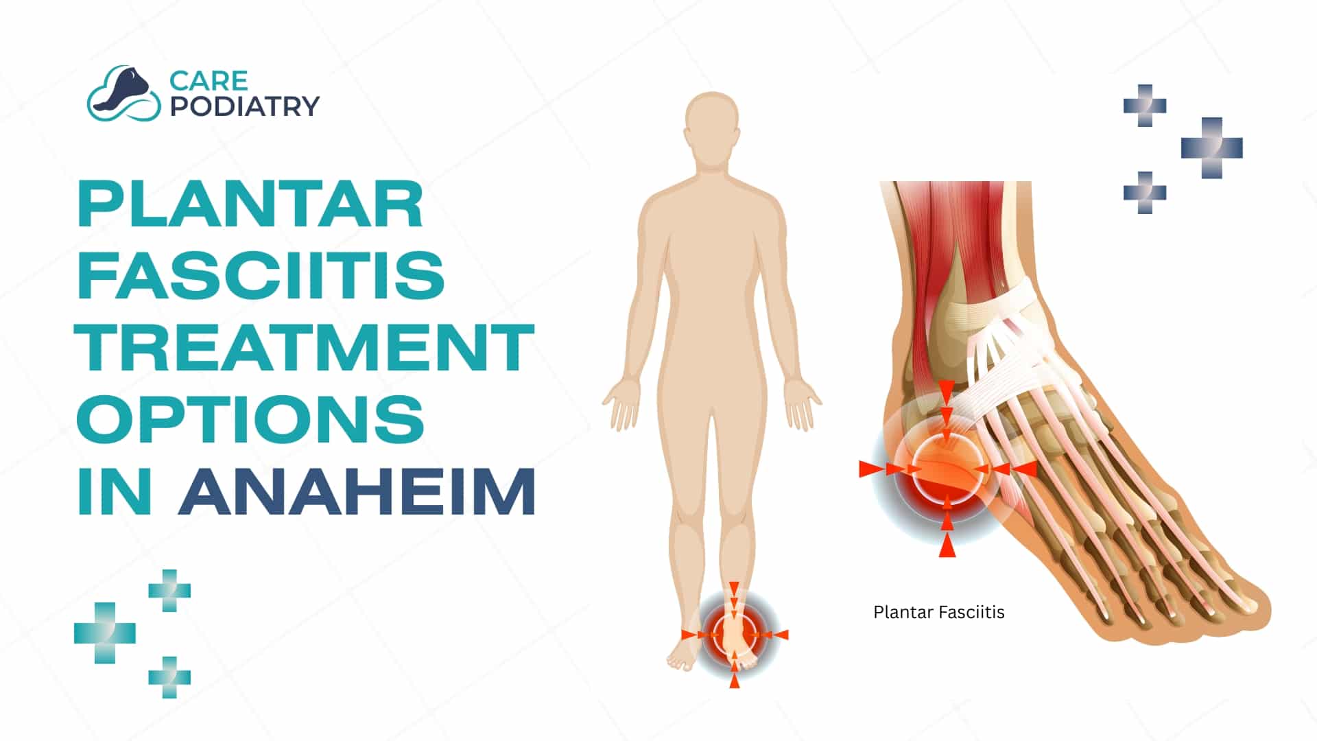 Plantar Fasciitis Treatment Options in Anaheim