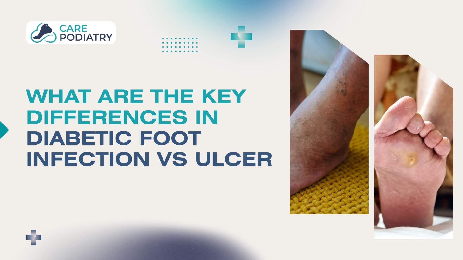 Diabetic Foot Infection vs Ulcer